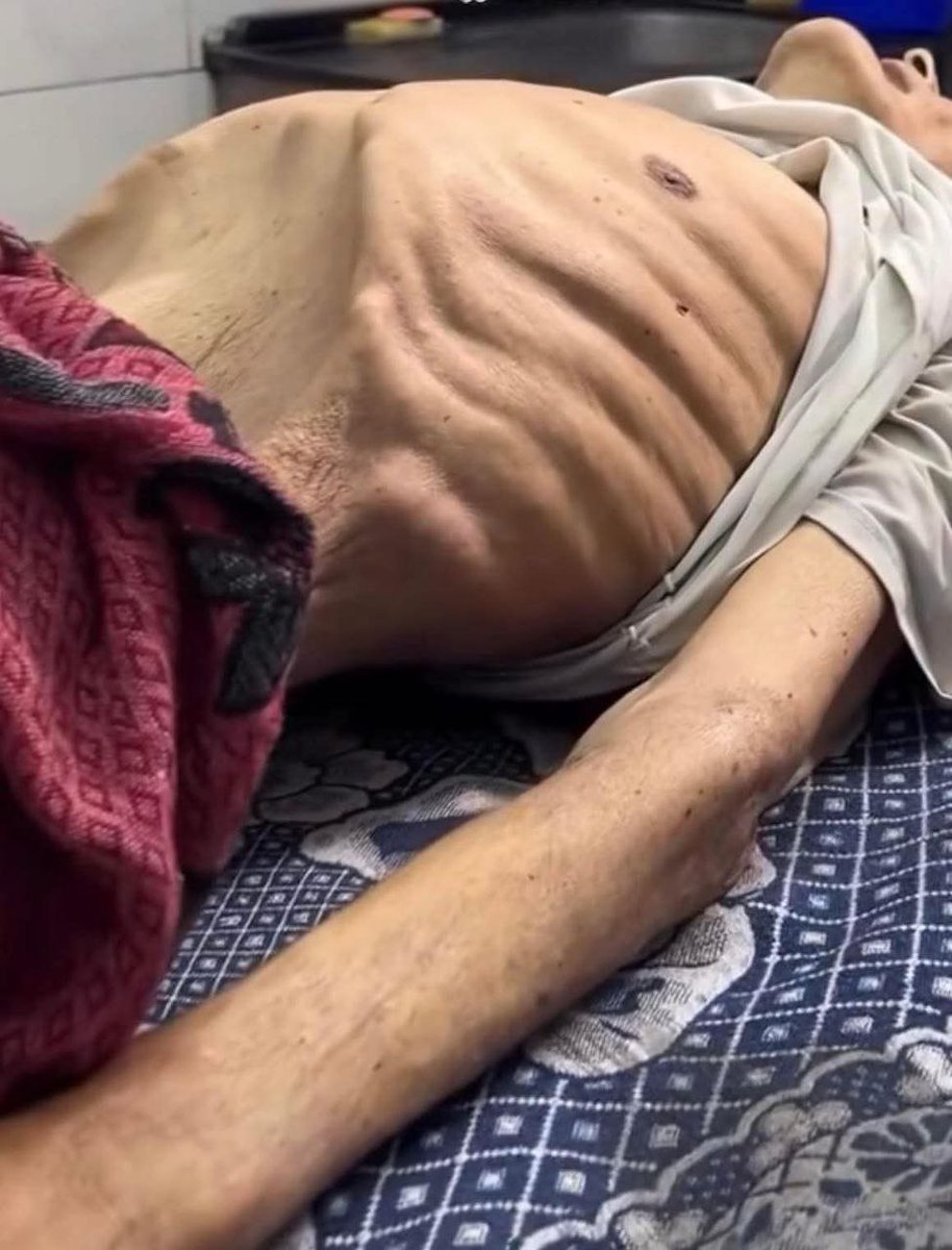 حالة وفاة جديدة نتيجة الجوع في غزة 🇵🇸