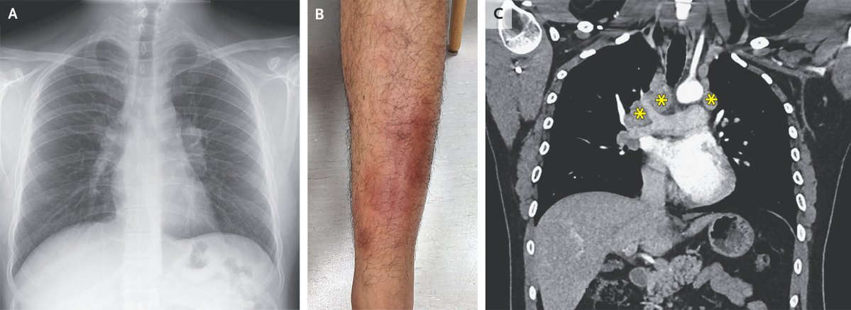 Síndrome de Löfgren | Jornal de Medicina da Nova Inglaterra nejm.org/doi/full/10.10…
