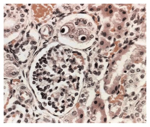Nico Gagelmann (@nicogagelmann) on Twitter photo Patient with multiorgan failure. Diagnosis & treatment?🦉 Patient with multiorgan failure. Diagnosis & treatment?🦉