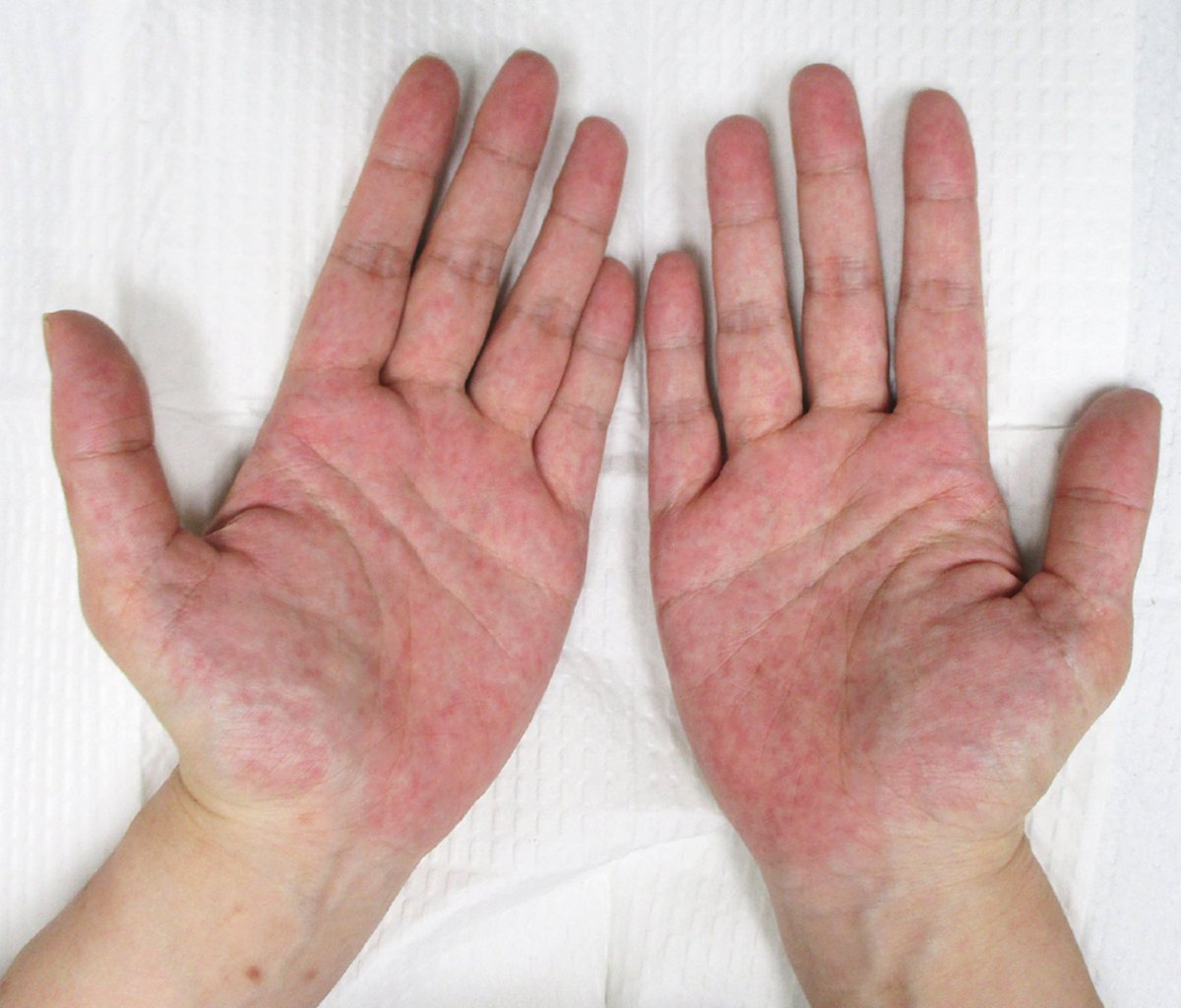 drsthanus's tweet image. A pregnant 33-year-old woman at 35 weeks’ gestation
No pain and pruritus
Otherwise asymptomatic.
first appeared during the second trimester of pregnancy.
Diagnosis?
Ddx?