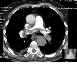 radRounds's tweet image. Patient with chest pain. Dx?