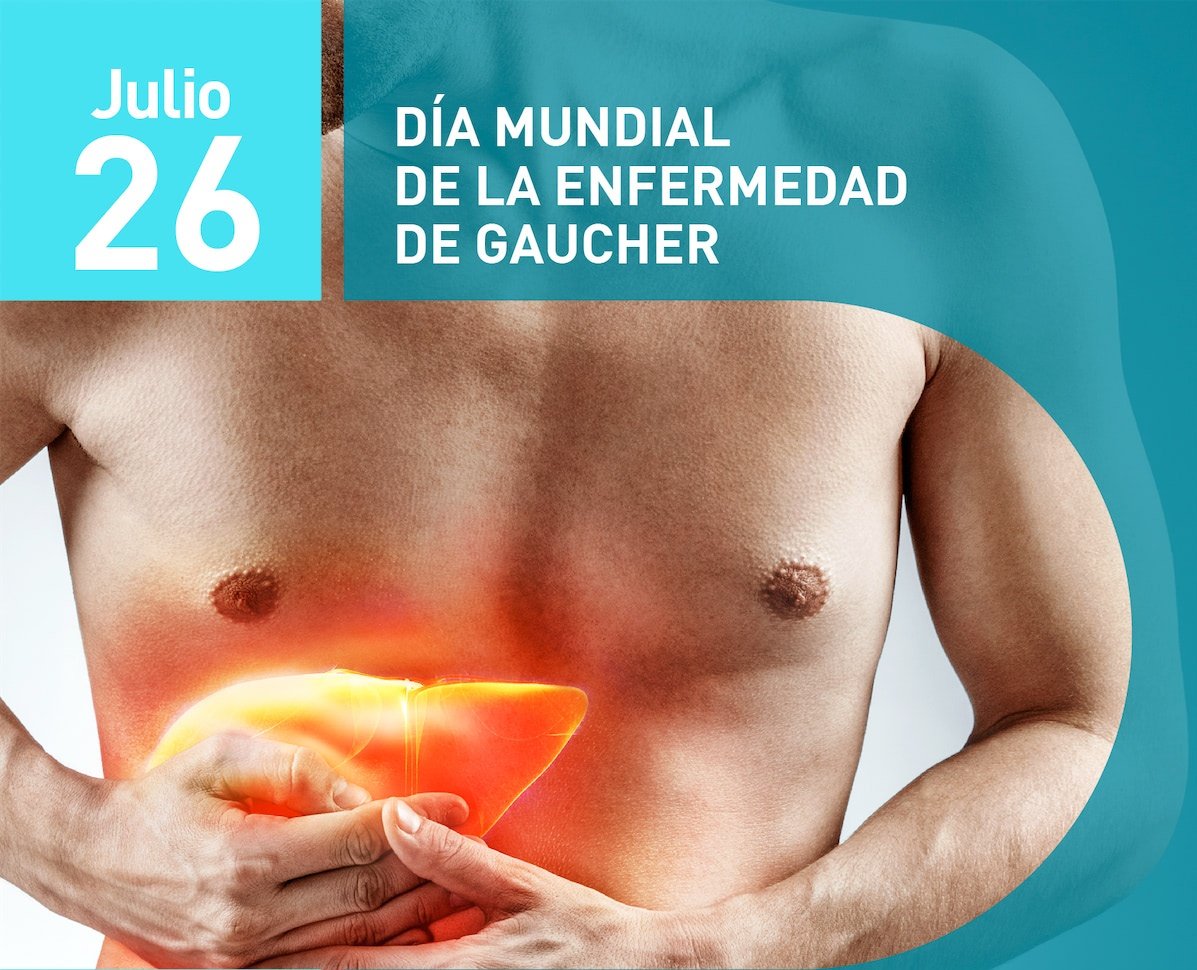 SilvanaDFrances's tweet image. Día Mundial de la Enfermedad de Gaucher.
La enfermedad de Gaucher es un trastorno metabólico hereditario causado por la falta de una enzima llamada glucocerebrosidasa, lo que provoca la acumulación de sustancias grasas en órganos como el bazo, hígado, pulmones y huesos.