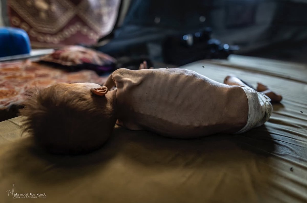 ibm_hmdn's tweet image. This child was deemed a threat to Netanyahu and his extremist government — so they deprived him of baby formula.
@SavetheChildren @savechildrenuk
#SaveGazaChildren #GazaStarving