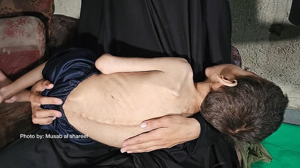 Timesofgaza's tweet photo. The two brothers, Abdul Rahman Matar (6 years old) and Anni (4 years old), are facing the risk of death due to severe malnutrition. Both suffer from cerebral palsy and physical as well as intellectual disabilities. https://t.co/sMxBGuE7jO