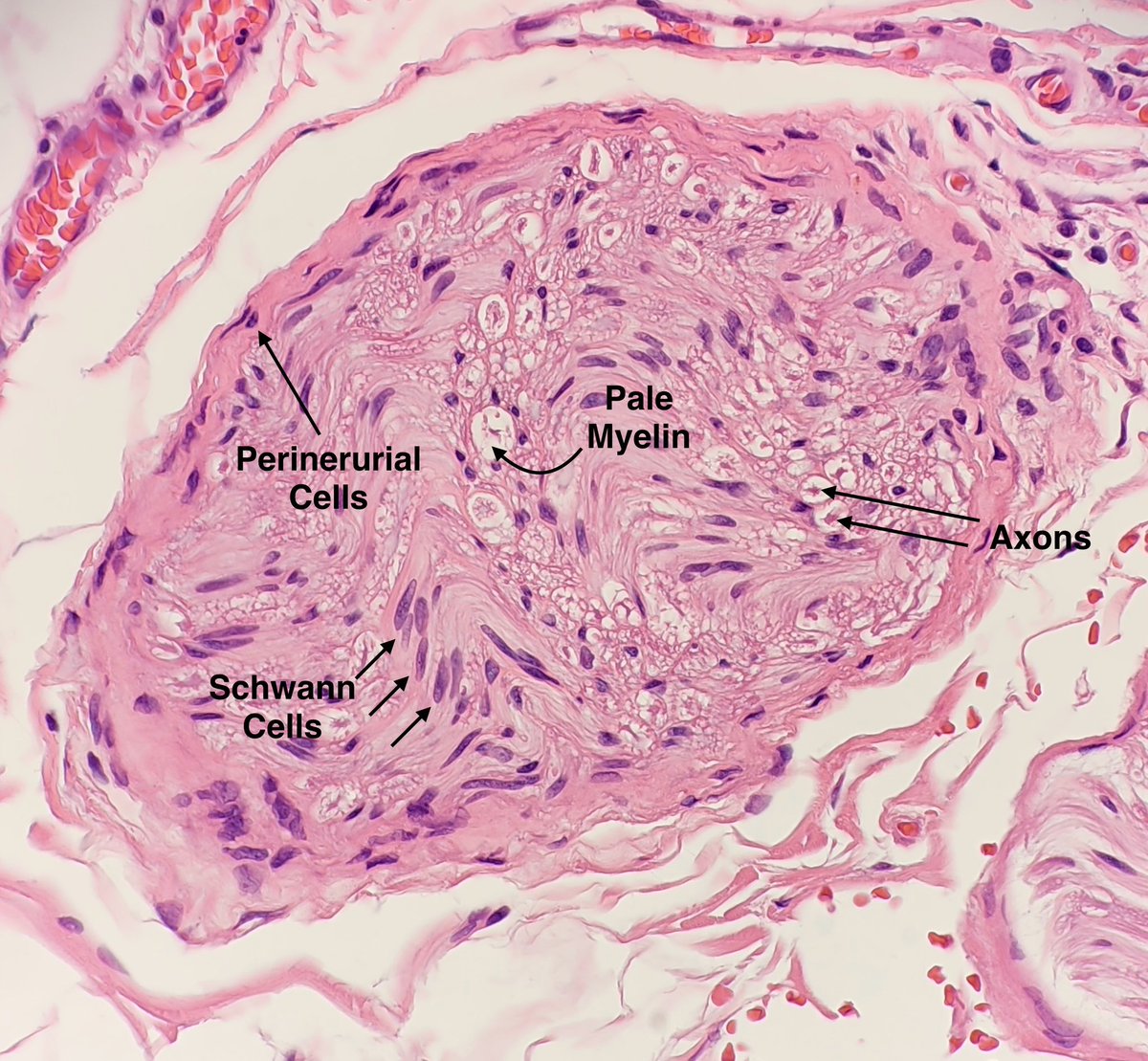 MBBS_Pathology's tweet image. Happy Saturday 💜
Today, I have a beautiful nerve to share with you with axons, lipid-rich myelin, #SchwannCells and perineurial cells labelled.
Hope you like it and that it helps with learning.
#histology
#pathology
#dermatology
😉