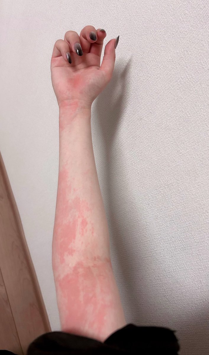 扁桃炎治ったと思ったら今度は全身蕁麻疹でてきて泣いてる
体が全力で仕事を拒否してる