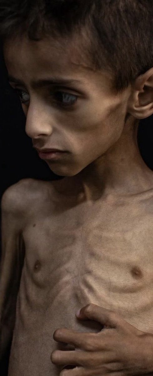 Donzelli's tweet image. Tutti a gridare che la Meloni è vigliacca su Gaza utilizzando la foto di questo bambino.
Una buona notizia: Osama Al-Raqab, che era malato di fibrosi cistica, ora sta bene. Sapete dove è adesso, curato e coccolato? Nella nostra Italia. Come molti altri bambini palestinesi.
Se…