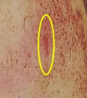 DavePollak4's tweet image. ne ho fatto cenno giorni fa.
questo taglietto (foto 1) a poca distanza dal grosso ematoma sulla coscia di #ChiaraPoggi, ci racconta una breve storia...
breve ma determinante...
in live domani sera, ore 19:50 sul canale Youtube:
"Storie Perdute - i Lati Oscuri della Storia" a…