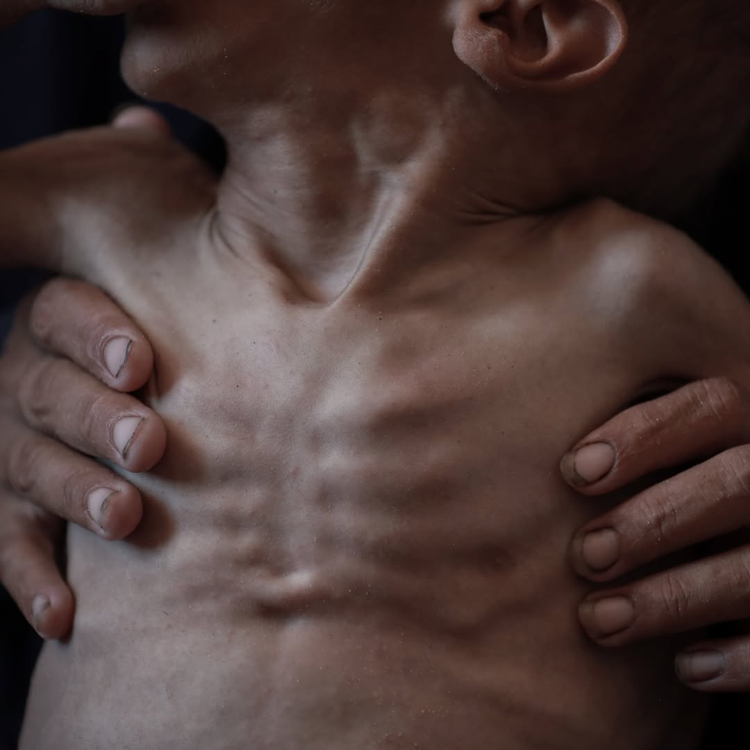 الطفل محمد المطوق "3 سنوات"، يعاني من سوء تغذية حاد نتيجة استمرار الحصار على غزة ومنع إدخال المساعدات الإنسانية والمكملات الغذائية.