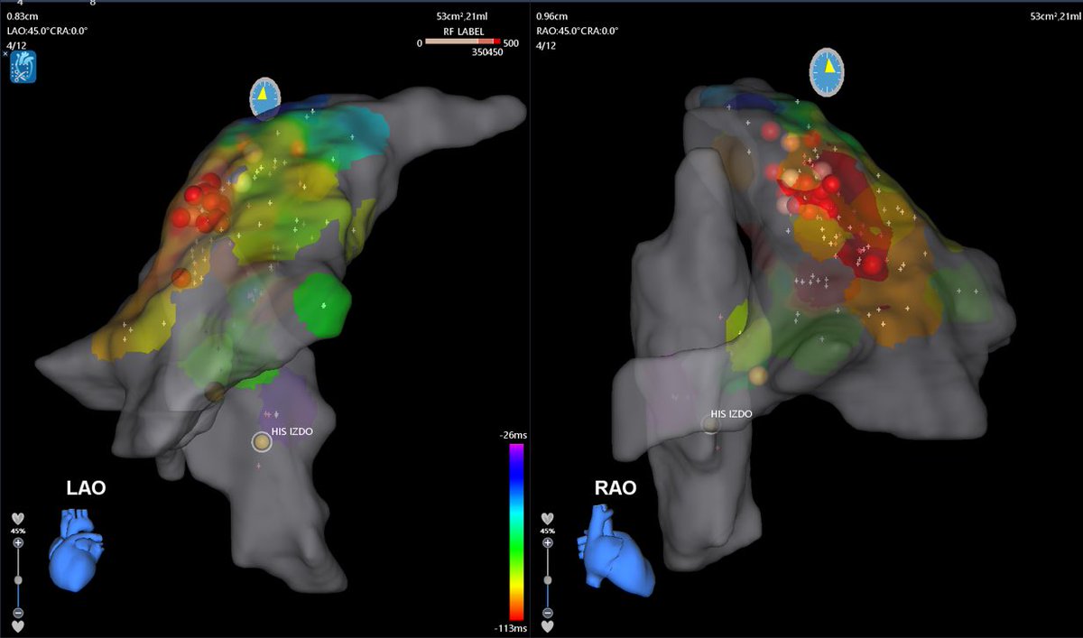 RVOT PVC in a patient with RV dilatation. It was a complex case because of the anatomy. The 1th image shows a nice monopolar EEG with “warm-up” phenomenon during ablation. <a href="/ArritmiasJMO/">Arritmias H. José Molina Orosa</a> #Epeeps #Cardiology