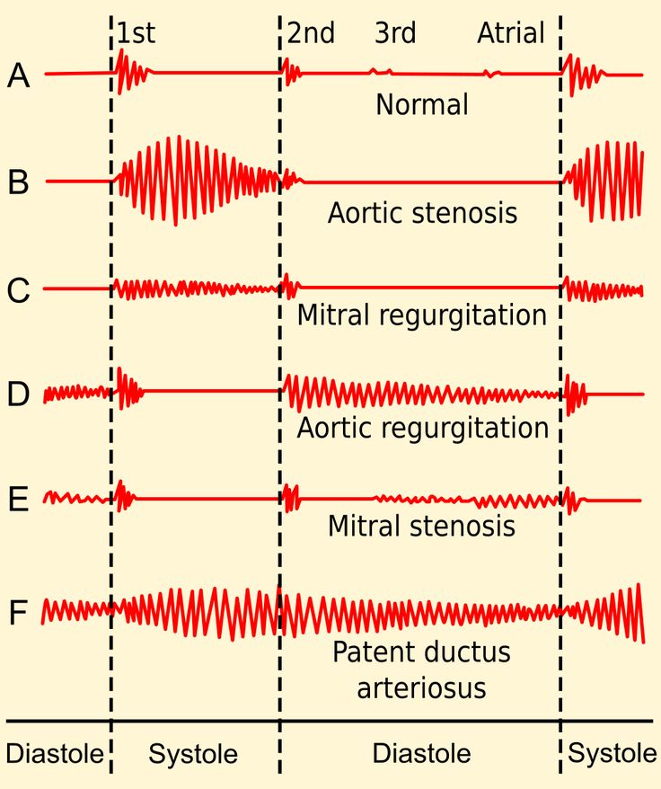 Ahmedata7777's tweet image. Heart murmurs