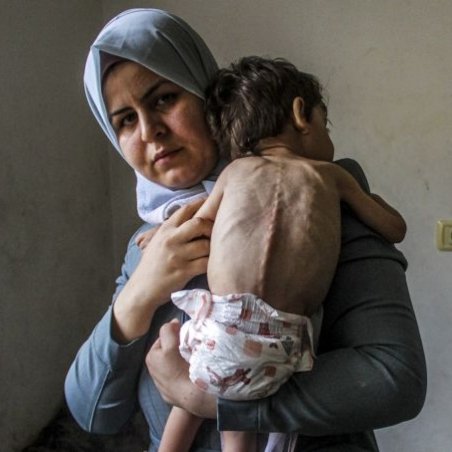 In the future, scientists will have to study the strange phenomenon of the famine in Gaza that seems to impact only little children.
Adults seem to be immune!
