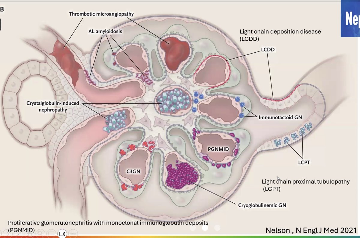 Myeloma kidney