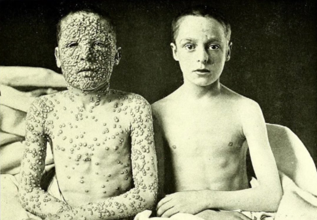 Guess which one was vaccinated?