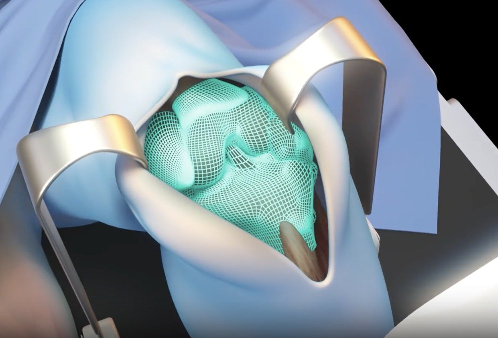 VISIE Executes First Pin-Free Knee Bone Cuts Using Spatial Computing

orthofeed.com/2025/07/26/vis…

#ComputerVision #EnablingTechnology #innovation #RoboticSurgery #SpatialComputing #SurgicalNavigation #TKA #TotalKneeArthroplasty