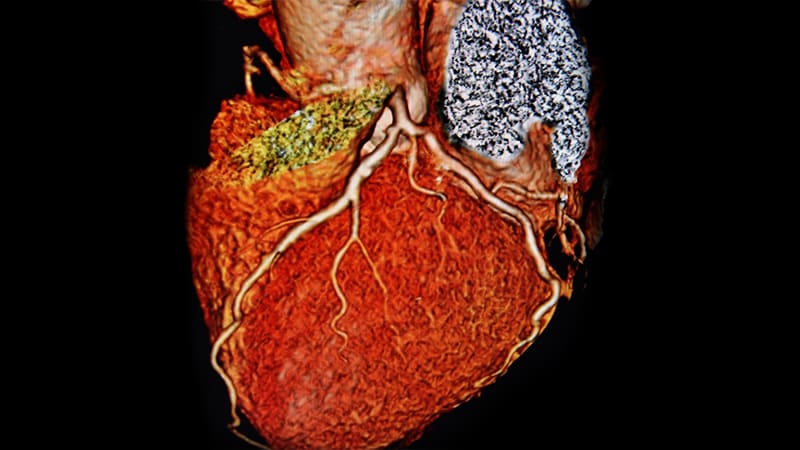 MedscapeES's tweet image. La angiotomografía computarizada "extendida" para incluir la porción superior del corazón revela trombos cardioaórticos en 1 de cada 14 pacientes con ictus isquémico agudo, lo que puede optimizar el manejo y prevenir recurrencias.
ms.spr.ly/6019s1e3h