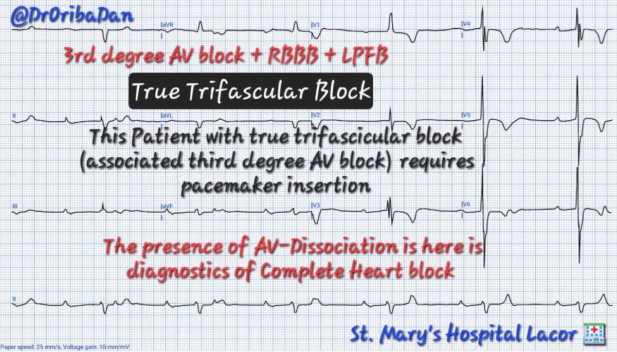 ECG breakdown. 
This patient has true Trifascular Block 
[3rd degree heart block, RBBB, LPFB]
✍️[AV-dissociation, P-wave after QRS] = Complete Heart block 
✍️[RAD, rS complexes in leads I &amp; aVL
qR complexes in leads II, III &amp; aVF&amp; prolonged R wave peak time in aVF] = LPFB.