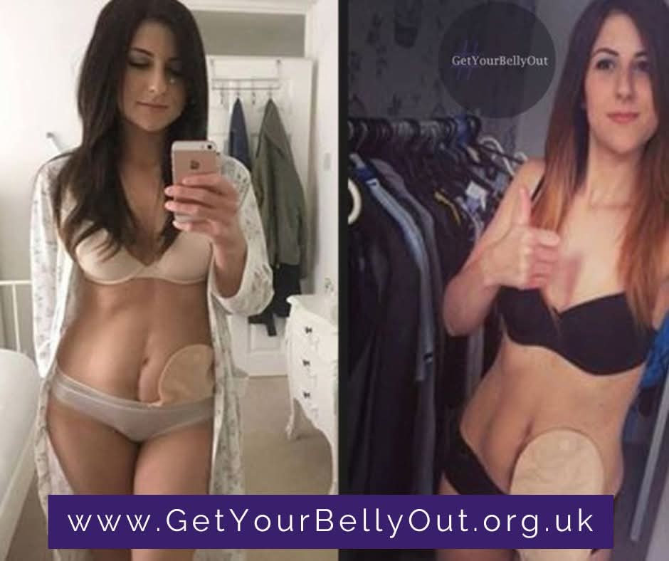 GetYourBellyOut's tweet image. My #GetYourBellyOut story: Laura Jane
I was diagnosed with Ulcerative Colitis at the age of 11, but was misdiagnosed as having IBS (irritable bowel syndrome) a few years prior to that. Initially, after my diagnosis, I was scared as I had never heard of Inflammatory Bowel Disease