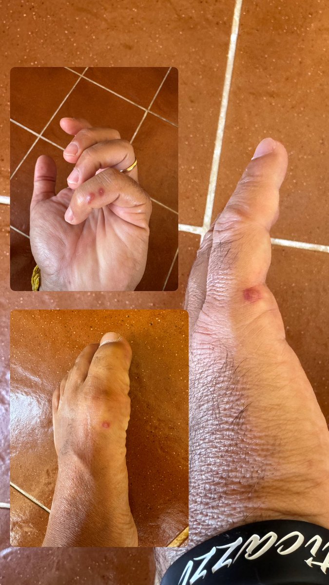 Morso più volte da un #ragnoviolino, così tanto per…