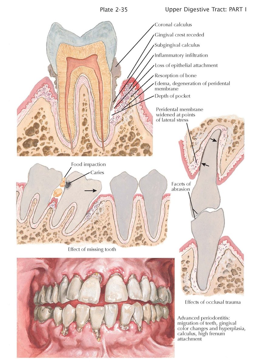 OviDentalGo's tweet photo. 🚫 Periodontal Disease Disease of the periodontal tissues constitutes the chief reason, more prevalent even than dental caries, for the loss of teeth. It is almost universally present among adults. https://t.co/dLt21HDCeJ