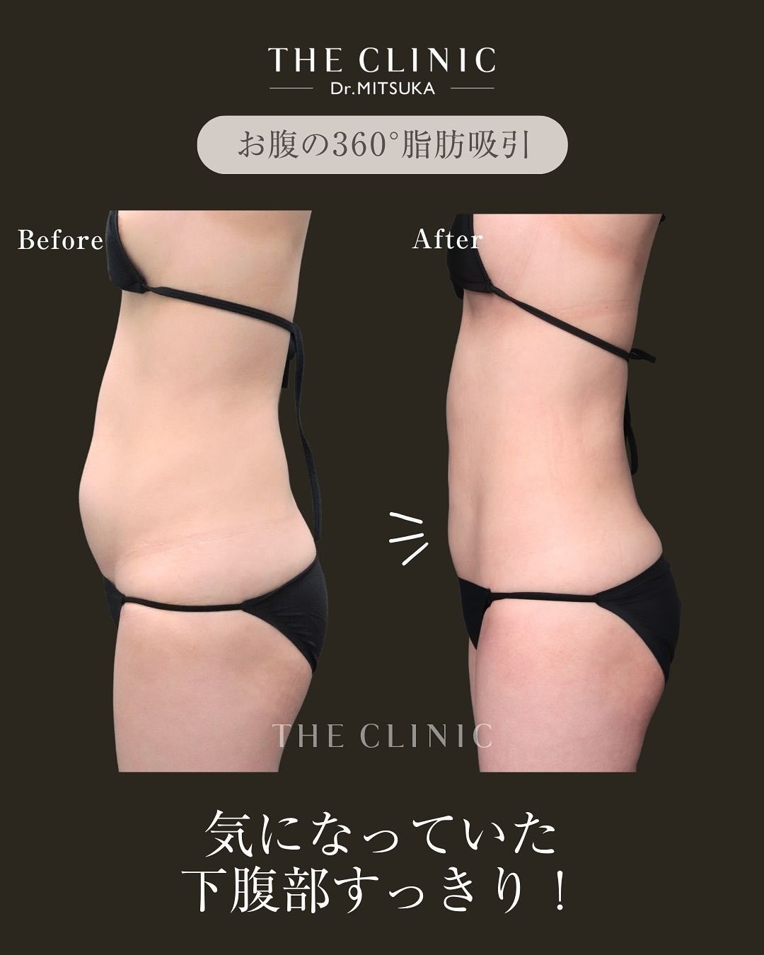 THE CLINIC ザクリニック　脂肪吸引　圧迫着　お腹背中腰S美品 THE CLINIC（ザ・クリニック）脂肪吸引ブログさんのプロフィール