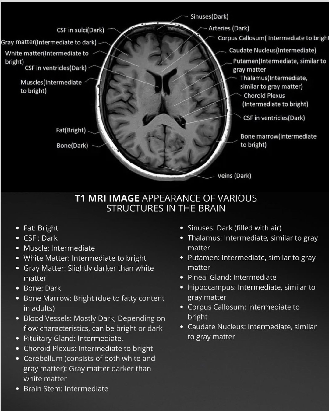 Dr sthanu subramanian on X: T1 MRI image of the brain, illustrating the  appearance of various structures based on their signal intensity (bright,  intermediate, or dark). t.coyrgcTDQc1z. t.cou5ioNp3Hjv   X