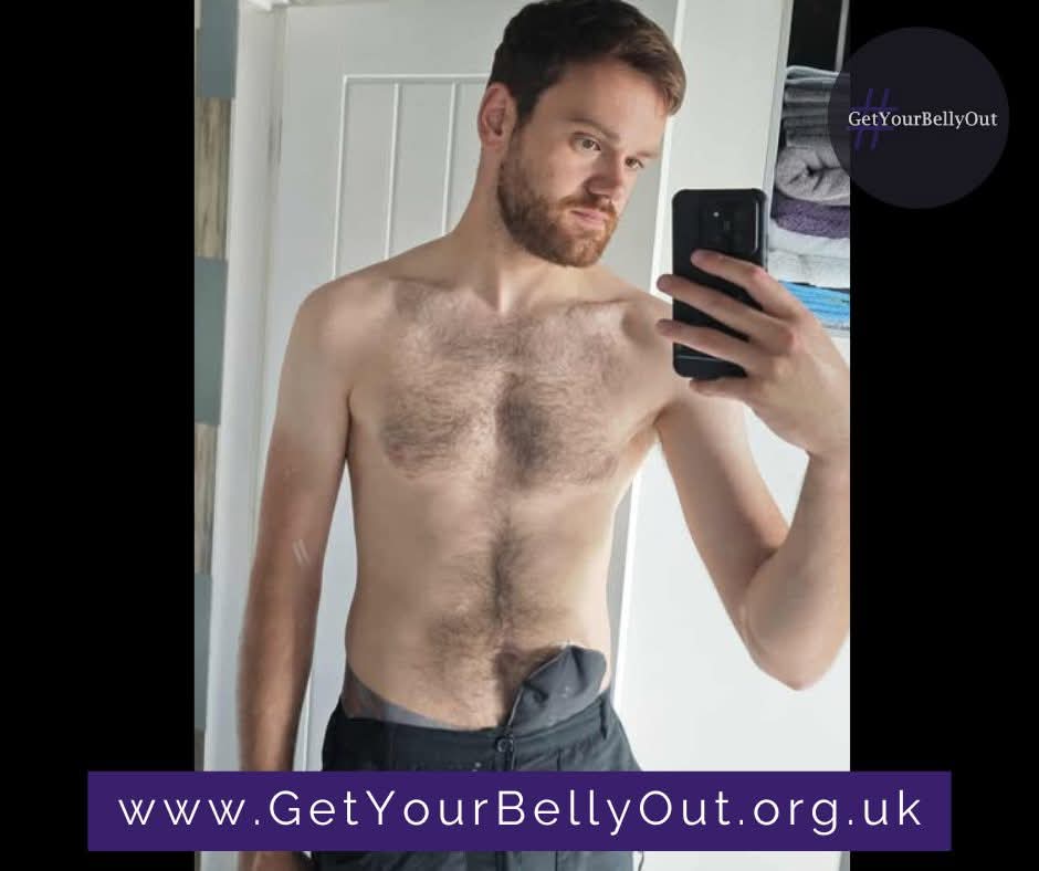 GetYourBellyOut's tweet image. My #GetYourBellyOut story: Oliver
I was diagnosed with Crohn's Disease following a colonoscopy back in 2022. I had been getting blood in my stool, and naturally, the first thing I thought of was bowel cancer. I didn't really know much about Crohn's Disease, and the diagnosis took
