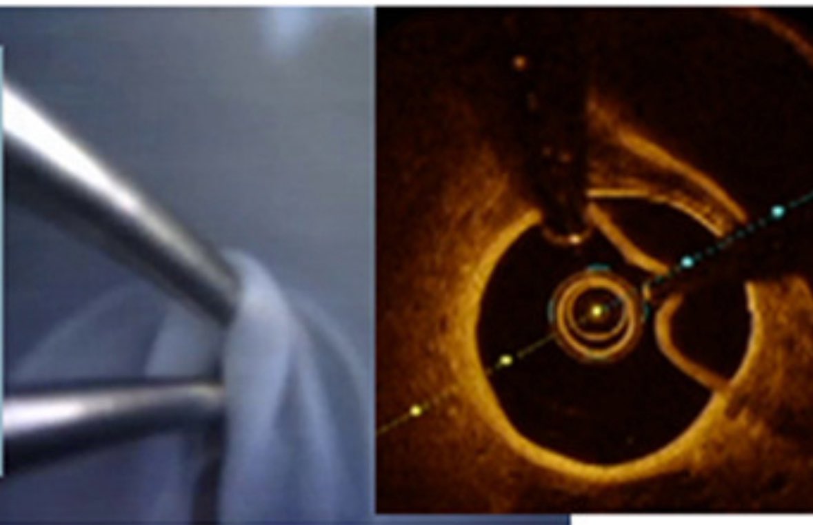BURZOTTA_F's tweet image. Want to see how iatrogenic #coronary artery dissections occurring during #PCI might look like? Unique images from  #VHL published. sciencedirect.com/science/articl…