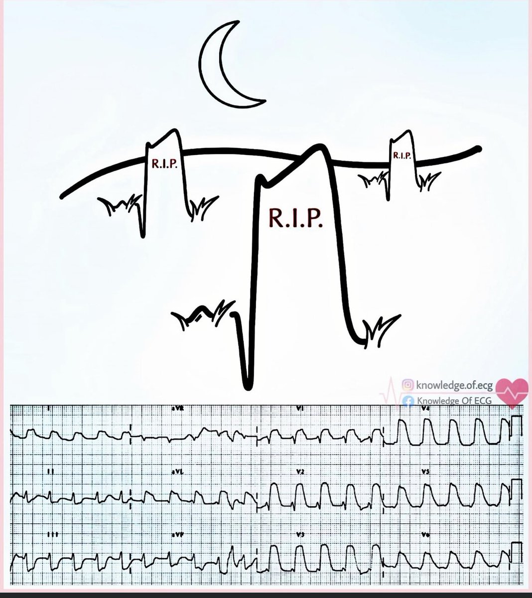 Differential Diagnosis of ST-Segment Elevation

ST-segment elevation on ECG isn’t always a heart attack. Here’s a breakdown of cardiac and non-cardiac causes every clinician should keep in mind. 🧵
