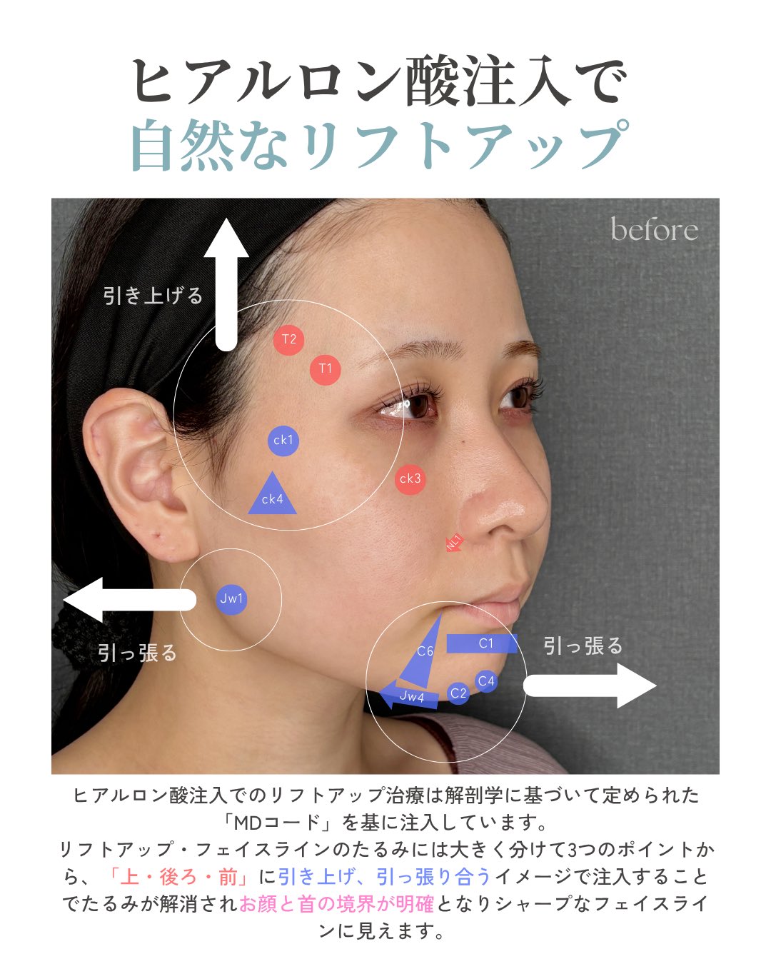 裁断済　フェイシャル・フィラー 注入の極意と部位別テクニック フェイシャル・フィラー Facial Filler | 克誠堂出版