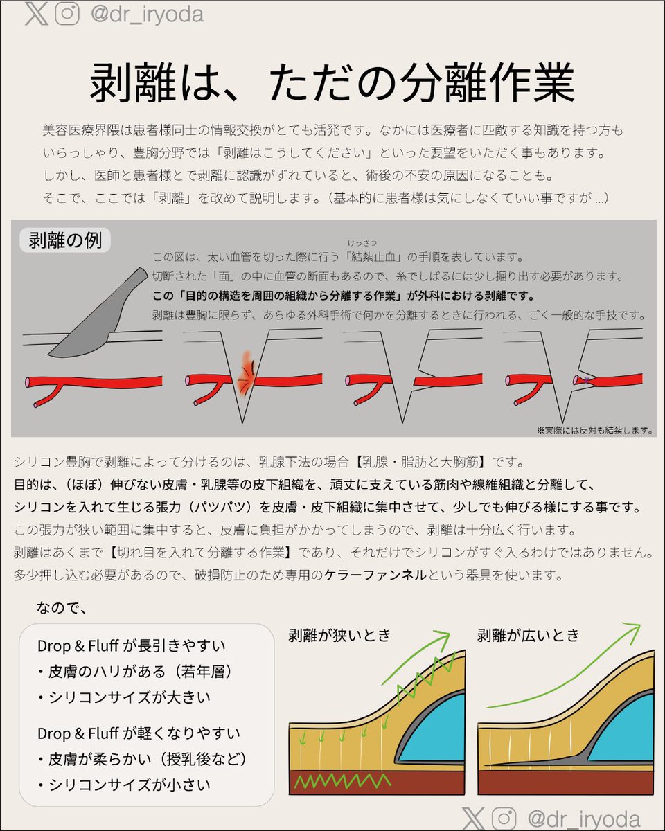 dr_iryoda's tweet photo. シリコン豊胸後の【Drop & Fluff】についてまとめてみました！
おすすめの解釈は【なじんで、ふわふわ】です。

術後3-6ヶ月の経過でバストがやや下垂し柔らかくなる(ちょっと大きくなる)現象として認知されています

何だか特殊な難しい話のようですが、医療者からすると普通な事です
この感覚の差は【剥離に対する認識のズレ】に原因があると前々から思っていました

仕上がりがどうなるか毎日不安な患者様と、Drop & Fluffなんて当たり前だから経過観察とする医師のズレが、
時には患者様の不安を悪化させていると思います。
なので今回まとめてみました！

実はDrop & Fluffというのは正式な医学用語ではなく、スラングです
私も教科書でなく、Nanaさん(@drop_and_fluff )のポストで初めて出会った単語です。
色々な解釈がありますが、私的には「なじんで、ふわふわ」で十分です。

残念ながら美容の世界は弱肉強食のような面があり、最近は患者様が自衛のために医療者レベルの知識を備えていたりします
素晴らしいことなのですが、特に外科的な感覚が必要な【剥離】についてはズレが起きていることが多いと感じています。

ポイントは
「剥離はただ切れ目を入れているだけで、皮膚は全然伸びない」ということです。
シリコンは、伸びない皮膚を頑張って少しだけ伸ばして、出来た隙間に押し込まれている状態です。

ですから、最初はピチピチ・パツパツで
皮膚が伸びるとゆったりしてくるんです。
それだけ、と言えばそれだけですが、これがDrop & Fluffの本質ではないかと考えています。

なのでもし、読んでくださっている方の中に
シリコン入れて1ヶ月経ったけど、思ってたのと違って悲しい…みたいな方がいたら
是非半年は待ってあげてください😢

かなり専門的で、患者様は絶対に知らなくて良い内容が含まれています。
ただ、せっかくならDrop & Fluffを調べた方が納得するように剥離の説明も含めました。

参考になれば幸いです！

#シリコン豊胸 #ハイブリッド豊胸 #脂肪豊胸
#drop&fluff