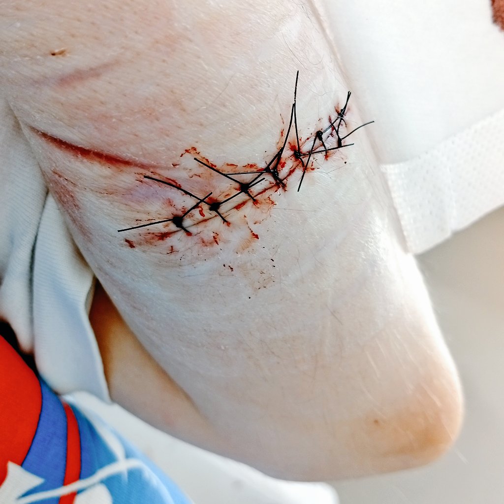 They saw I opened it up again, so they brought be back to the ER where they cut off the healing skin so it can properly heal all over again
#shtwt #shedtwt