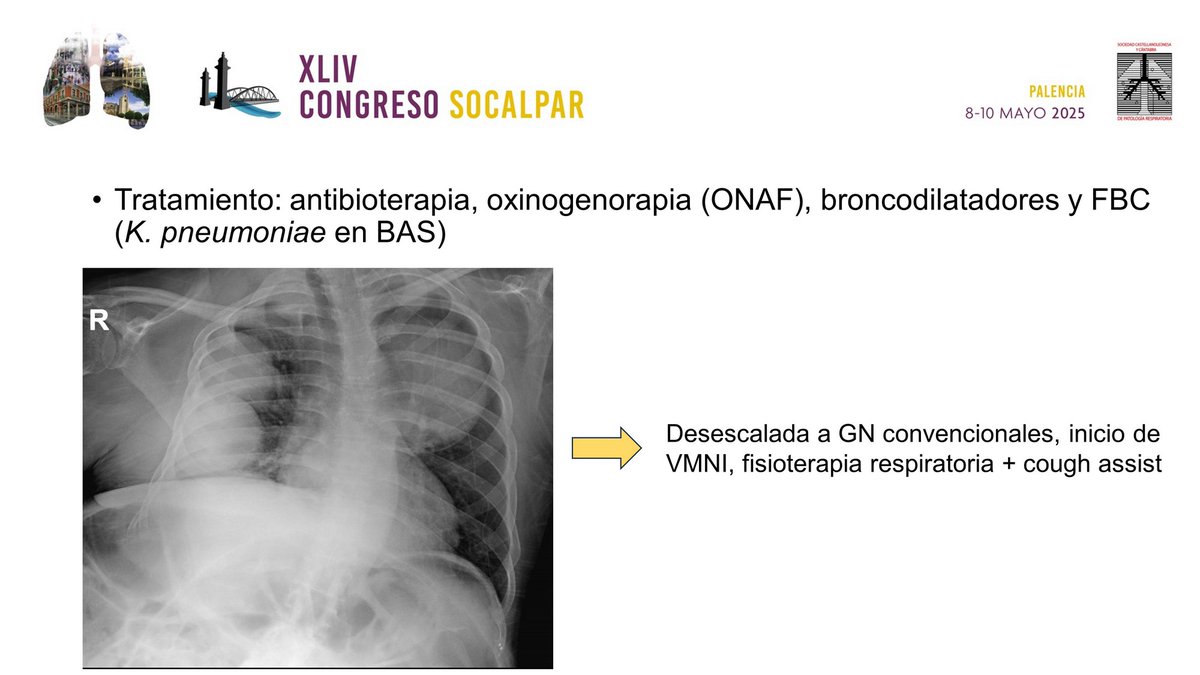 📝 #CasoClínico: "De La Genética A La Unidad De Cuidados Respiratorios Intermedios (UCIR): Infección Respiratoria Grave En Un Paciente Con Neurofibromatosis Tipo 1"  1/2

Hospital Clínico Universitario de #Valladolid