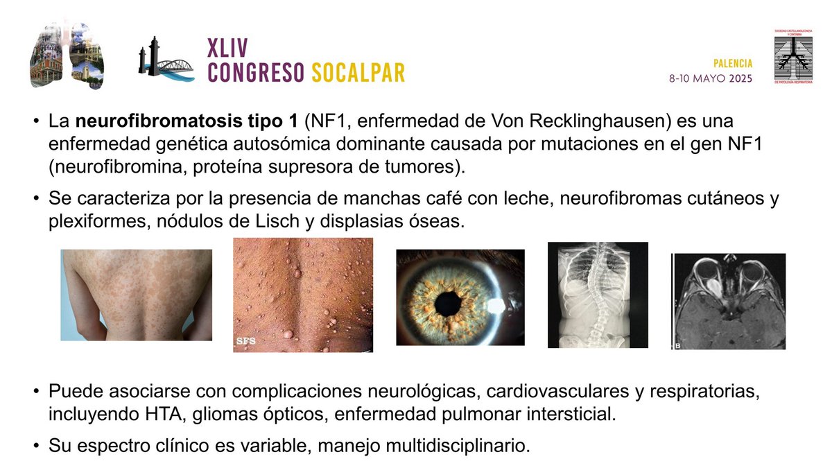 📝 #CasoClínico: "De La Genética A La Unidad De Cuidados Respiratorios Intermedios (UCIR): Infección Respiratoria Grave En Un Paciente Con Neurofibromatosis Tipo 1"  2/2

Hospital Clínico Universitario de #Valladolid