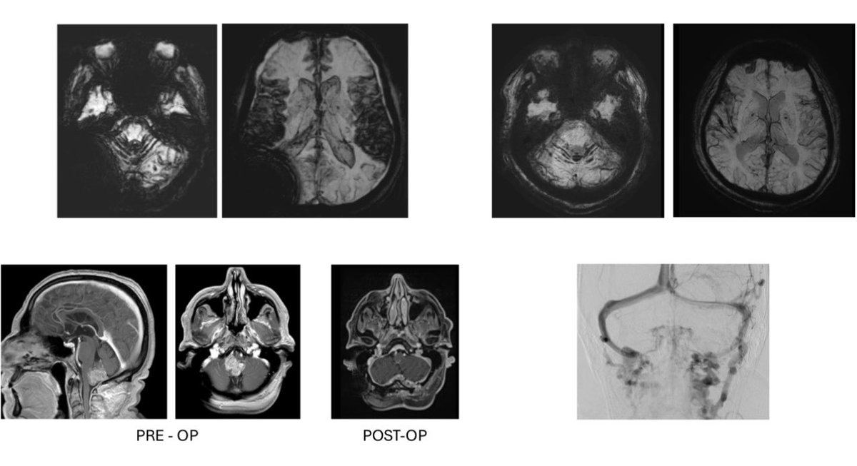 WouterSchievink (@wouterschievink) on Twitter photo 90+% of patients we see with infratentorial superficial siderosis have an underlying spinal CSF leak. This week we saw two other causes: a IVth ventricular ependymoma (postop dural thickening from overdraining shunt) and bilateral jugular vein occlusion <a href="/LivingwithSS/">SSRA | Living with SS</a> 90+% of patients we see with infratentorial superficial siderosis have an underlying spinal CSF leak. This week we saw two other causes: a IVth ventricular ependymoma (postop dural thickening from overdraining shunt) and bilateral jugular vein occlusion <a href="/LivingwithSS/">SSRA | Living with SS</a> 