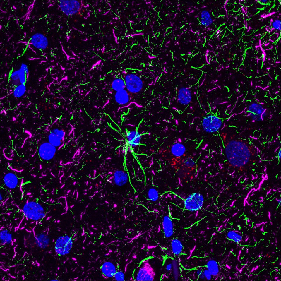 Beautiful examples of RNA in situ hybridization with additional immunofluorescence staining from Dr. Kimberly Fiock (<a href="/thepathphd/">Kimberly Fiock, PhD</a>)🧬
