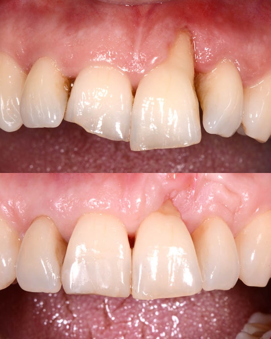 The rehabilitation of this periodontally compromised tooth required a multidisciplinary approach, combining both periodontal and orthodontic treatments.