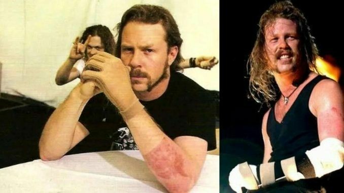 #JAMESHETFIELD While opening for GnR in Montreal on Aug.8/92, a pyrotechnics accident burns the entire left side of his body. James sustains 2nd and 3rd degree burns to his face, arms, hands and legs.