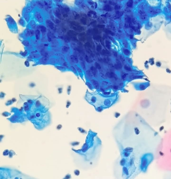 ABC Of Cytology Revision -5
T: Tissue Repair
Distinct intercellular borders. Low N/C ratio