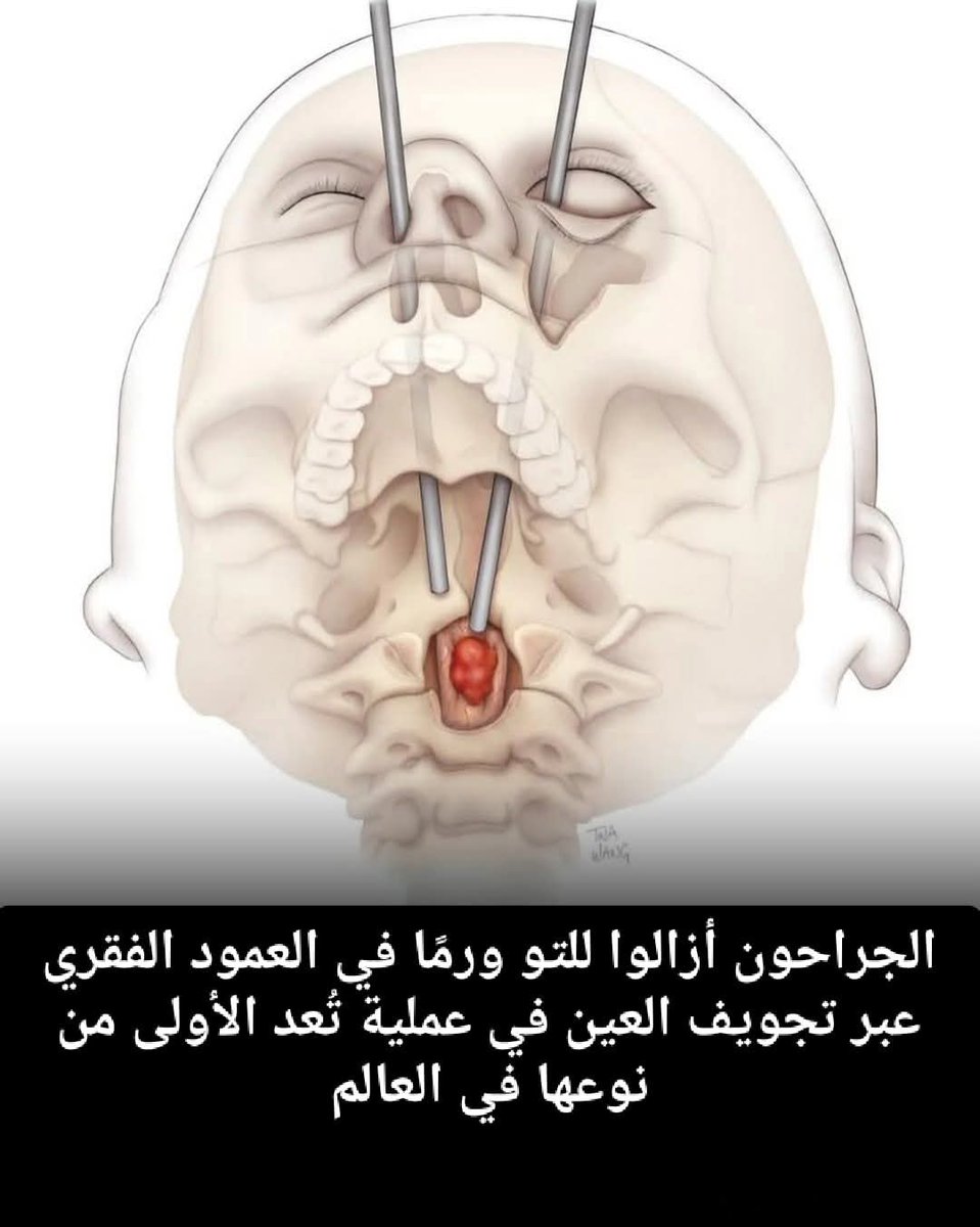 طبيب جراح مصري يقود إنجاز طبي تاريخي
الدكتور محمد لبيب (Muhammed Labeeb) هو أمريكي من أصل مصري.

اختراق جراحي غير مسبوق: إزالة ورم من العمود الفقري عبر العين!

في إنجاز طبي عالمي، نجح جراحو المركز الطبي بجامعة ماريلاند في إزالة ورم نادر من العمود الفقري لامرأة تبلغ من العمر 19