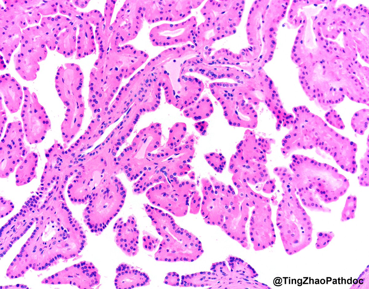 Ting Zhao, MD (@tingzhaopathdoc) on Twitter photo 60s M with a renal mass. What is your diagnosis?
#PathTwitter
<a href="/MGBpathology/">Mass General Brigham Pathology</a> <a href="/MGHPathology/">MGH Pathology</a> 60s M with a renal mass. What is your diagnosis?
#PathTwitter
<a href="/MGBpathology/">Mass General Brigham Pathology</a> <a href="/MGHPathology/">MGH Pathology</a>