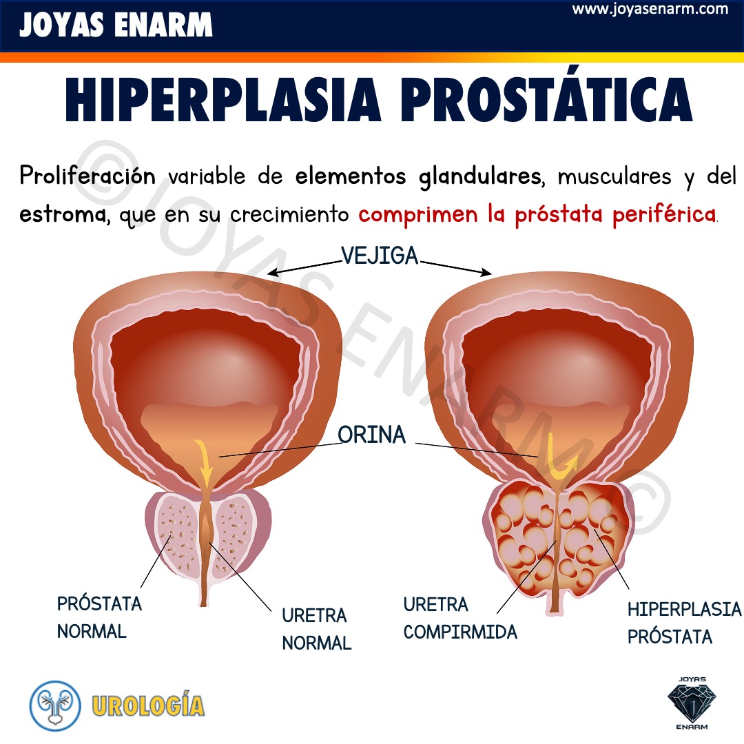 Joyas_ENARM's tweet photo. Hiperplasia Prostática Benigna 💎

MANUAL DE ESTUDIO #ENARM ENVÍO GRATIS EN:
https://t.co/O0EgHOtMah https://t.co/QuK0Blbmiv