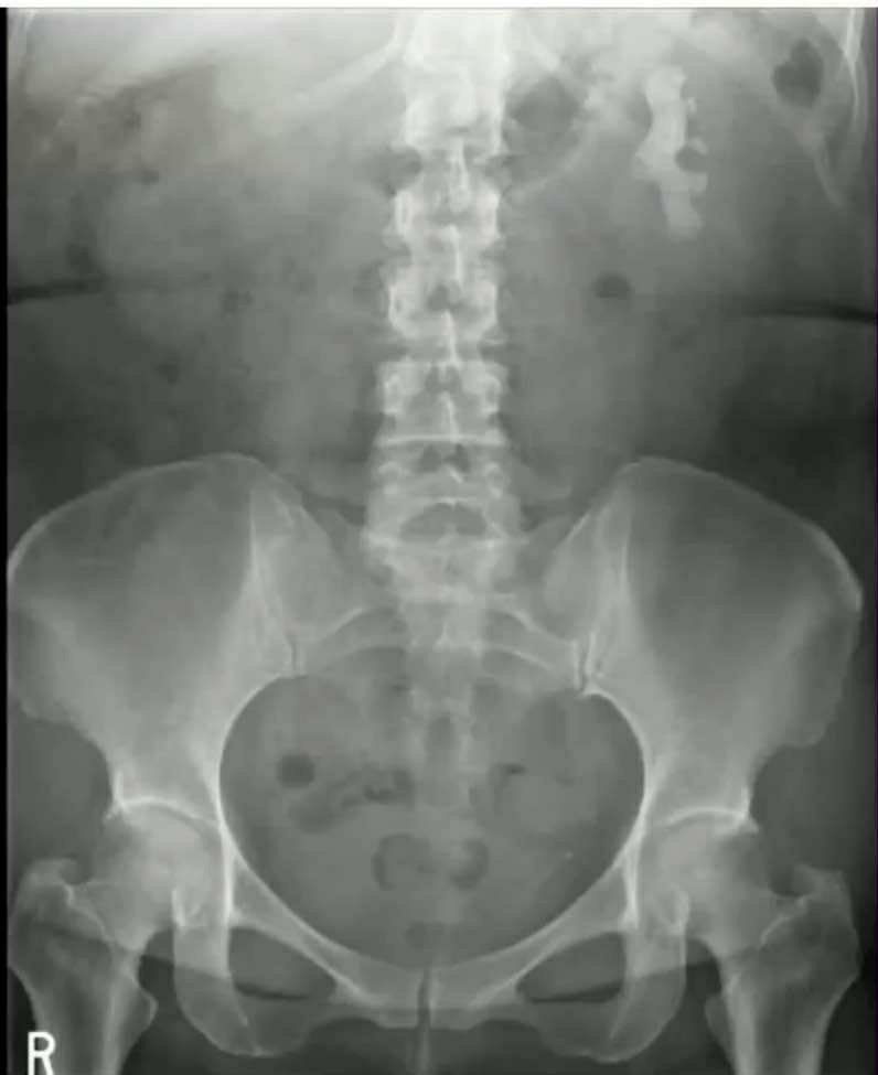 Classic left staghorn calculus filling the renal pelvis and calyces. Often linked to chronic infections like Proteus or Klebsiella. Can lead to sepsis or renal failure.
CT KUB is gold standard.
Treatment: PCNL with antibiotics or drainage if needed.
#Dottir #StaghornCalculus