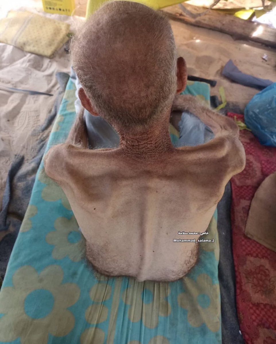 This is Hammad Abu Draz, 70 years old. He suffers from chronic kidney disease and is now battling severe malnutrition.

In June 2025, Israel destroyed Gaza’s only dialysis center, cutting off essential treatment for patients like him. It has also blocked the entry of life-saving