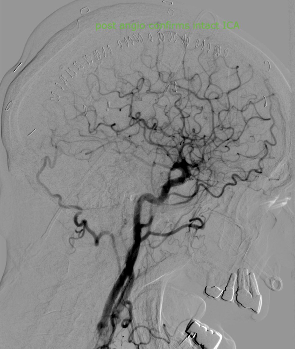 Mustafa Al-Roubaie (@alroubaiemd) on Twitter photo After injecting 2cc of 100-300um Embosphere solution (2cc particles diluted in 10cc contrast), I noticed no tactile slowing of flow w/ flushing. In this territory that is a red flag. DSA then showed contrast flowing into the subdural drain😂<a href="/MeritMedical/">Merit Medical</a> <a href="/Daryl_Goldman/">Daryl Goldman MD</a> #MMA #irad After injecting 2cc of 100-300um Embosphere solution (2cc particles diluted in 10cc contrast), I noticed no tactile slowing of flow w/ flushing. In this territory that is a red flag. DSA then showed contrast flowing into the subdural drain😂<a href="/MeritMedical/">Merit Medical</a> <a href="/Daryl_Goldman/">Daryl Goldman MD</a> #MMA #irad