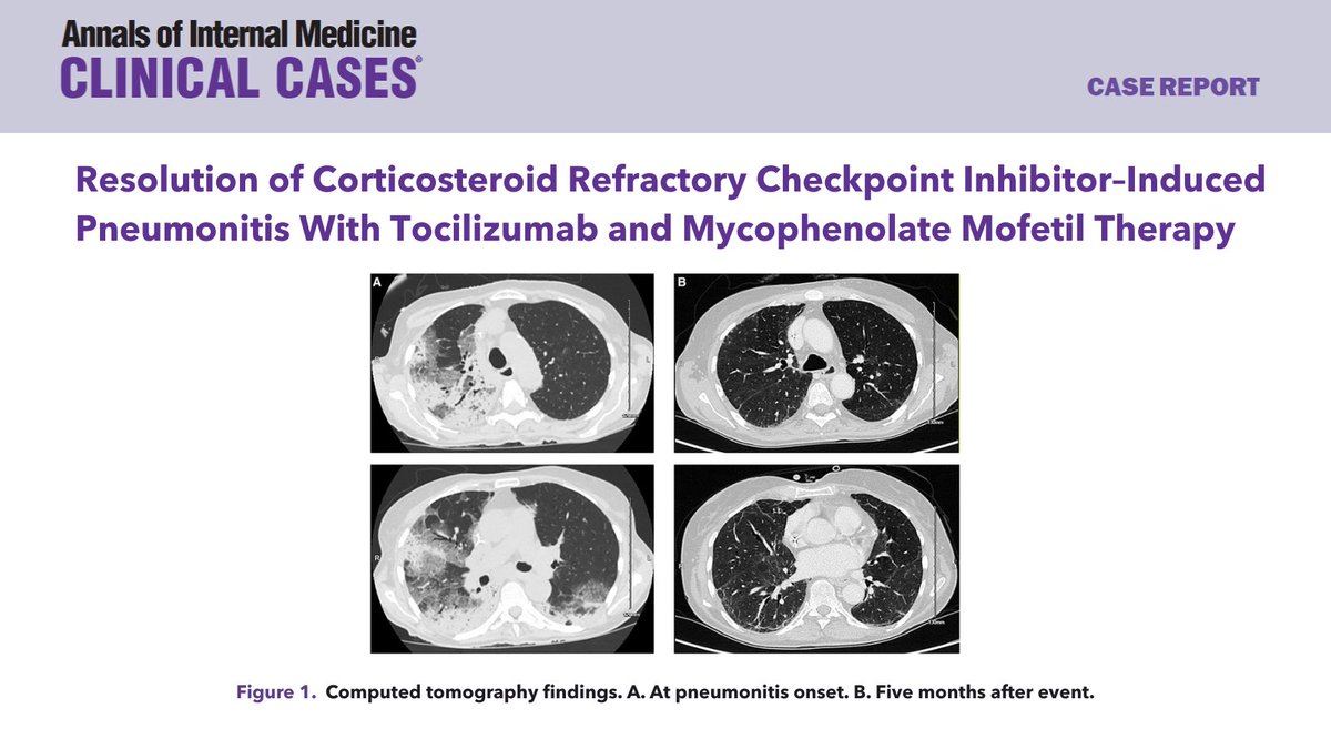 Annals of Internal Medicine: Clinical Cases (@annalsofimcc) on Twitter photo A case report underscores the critical role of intensified immunosuppressive therapy for managing steroid-refractory pneumonitis and highlights tocilizumab as a potential agent to reduce mortality. bit.ly/45aItNA <a href="/AHAScience/">AHA Science</a> #AHAJournals A case report underscores the critical role of intensified immunosuppressive therapy for managing steroid-refractory pneumonitis and highlights tocilizumab as a potential agent to reduce mortality. bit.ly/45aItNA <a href="/AHAScience/">AHA Science</a> #AHAJournals