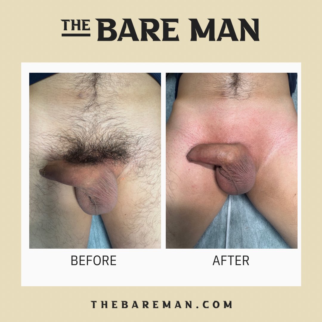Another transformation by The Bare Man! #wax #waxing #menwaxing #manzilian #beforeandafter
