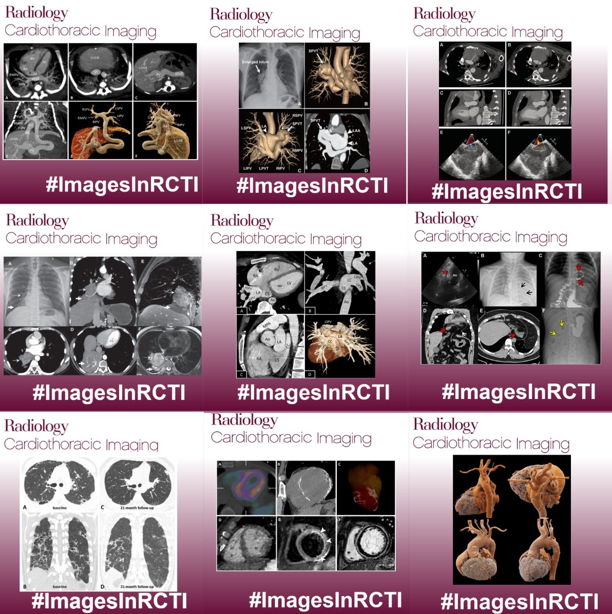 Francisco Calle (@fcallemd) on Twitter photo From July 2024 to July 2025, our Early Career Editorial Board boosted the reach of <a href="/RadiologyCTI/">Radiology: Cardiothoracic Imaging</a> with impactful content, expanding global access to high-quality cardiothoracic imaging research. 📈 <a href="/SuhnyAbbara/">Suhny Abbara MD</a> <a href="/KateHanneman/">Kate Hanneman</a> From July 2024 to July 2025, our Early Career Editorial Board boosted the reach of <a href="/RadiologyCTI/">Radiology: Cardiothoracic Imaging</a> with impactful content, expanding global access to high-quality cardiothoracic imaging research. 📈 <a href="/SuhnyAbbara/">Suhny Abbara MD</a> <a href="/KateHanneman/">Kate Hanneman</a>