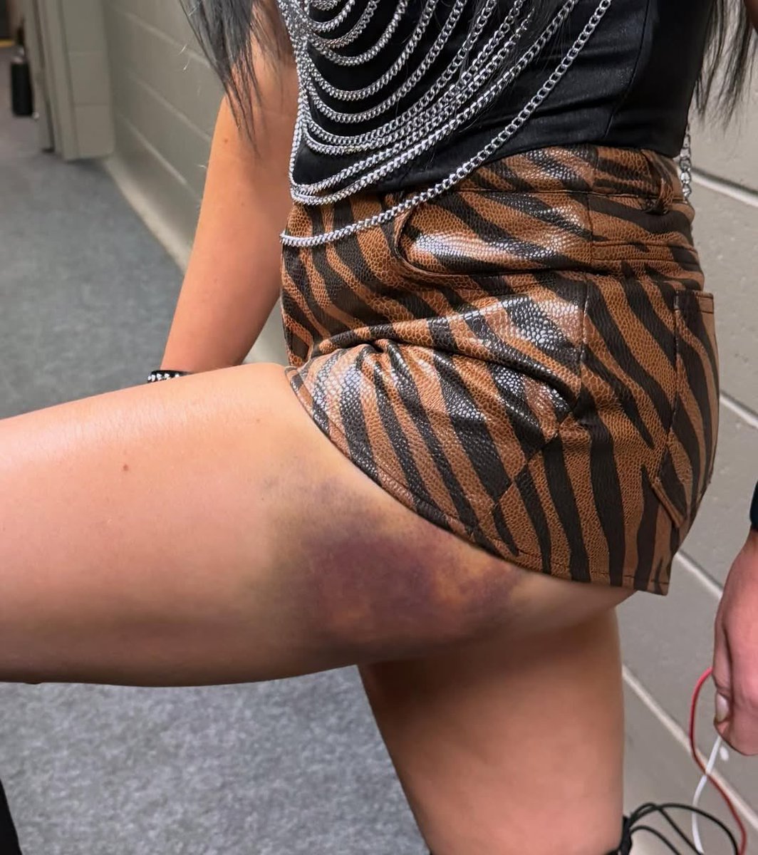 a bruise so bad it made candice post on instagram