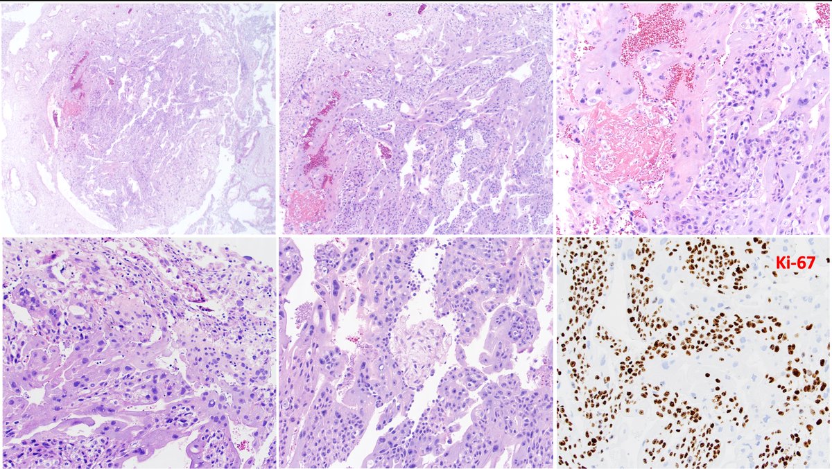 Pei Hui (@hui2pei) on Twitter photo Y-GTD Case of August 2025: Patient under 20 years of age, G1P0 at 5 weeks by LMP, underwent uterine D&C for an undesired pregnancy. <a href="/yalepathology/">Yale Pathology</a>
bit.ly/48Yq1pO Y-GTD Case of August 2025: Patient under 20 years of age, G1P0 at 5 weeks by LMP, underwent uterine D&C for an undesired pregnancy. <a href="/yalepathology/">Yale Pathology</a>
bit.ly/48Yq1pO